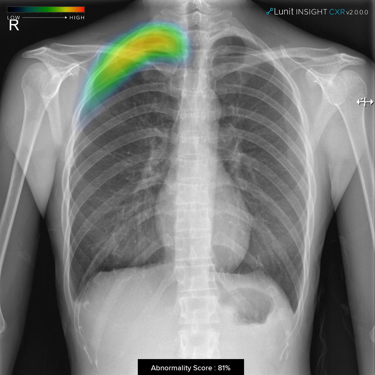 20191029 lunit PX4.dcm heatmap - 와우테일